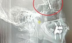 Implant Operasyonunun Korkunç Sonu: Vida Beyne Saplandı!