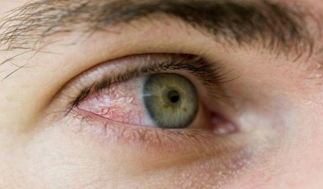 Bahar aylarındaki göz alerjisi görme kaybına yol açabilir